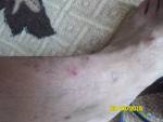 Что это за кожное заболевание, лечение? фото 4