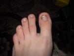 Грудное вскармливание и подозрение на грибок ногтей стопы фото 2