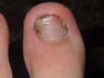 Грудное вскармливание и подозрение на грибок ногтей стопы фото 1