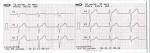 Расшифровка кардиограммы, ЭКГ фото 2