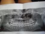 Перелом нижней челюсти фото 1