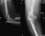 Перелом мыщелка логтевого сустава фото 1