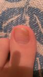 Синяк на ногте, стал желтеть ноготь фото 1