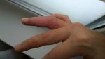 Мокнущая сыпь на пальцах руки фото 4