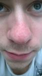 Проблемы с кожей носа фото 1
