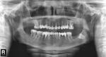 Удаление зубов фото 1