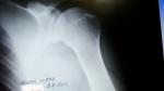 Перелом большого бугорка плечевой кости фото 4