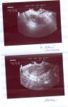Киста или беременность, слабая вторая полоска фото 1