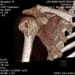 Оскольчатый вколоченный перелом плечевой кости фото 2