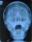 Рентген придаточных пазух носа расшифровка фото 1