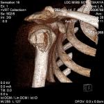 Оскольчатый вколоченный перелом плечевой кости фото 4