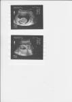 Вероятность рождения здорового ребенка с подобными маркерами УЗИ фото 5