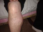 Збільшена і ущільнена нога в правій підколінній ямці фото 2