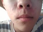 Сыпь на лице в течение 4 месяцев фото 1