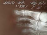 Суставной перелом фаланги(не ногтевой) большого пальца ноги фото 2