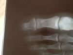 Суставной перелом фаланги(не ногтевой) большого пальца ноги фото 1