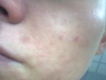 Высыпания на коже лица, алергия, акне фото 1