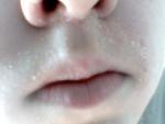 Шелушение над верхней губой, похожее на чешую фото 1