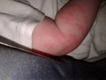 Сыпь на руках в районе сгиба локтя у ребенка 4 месяца фото 1