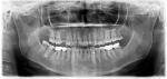 Наличие кисты на корне зуба фото 1