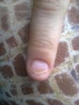 Отслоение ногтей от ногтевого ложе фото 1