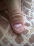 Отслоение ногтей от ногтевого ложе фото 2