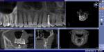 Проблема после пломбировки двух каналов на 24-м зубе вверху челюсти фото 4