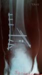 Трехлодыжечный оскольчатый перелом лодыжки с подвывихом фото 4