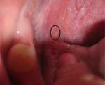 Лейкоплакия во рту фото 1