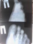 Осложнение после перелома пальца как лечить фото 1