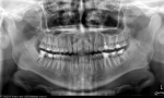 Зубная боль, расшифровка снимка фото 1
