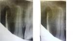 Проблема после пломбировки двух каналов на 24-м зубе вверху челюсти фото 2