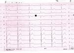 Расшифровка кардиограммы фото 3