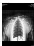 Артроскопия при двустороннем артрозе плечевых суставов фото 3