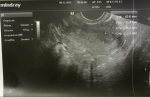 Расшифровка трансвагинального УЗИ на наличие/отсутствие беременности фото 1