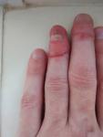 Последствия открытого перелома 4 пальца левой кисти фото 1