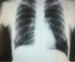 Диагностика туберкулеза подтверждение диагноза фото 2