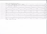 В анамнезе инфаркт миокарда 2008. Расшифровка ЭКГ и БХК фото 1