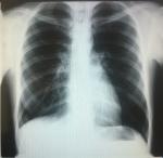 Диагностика туберкулеза подтверждение диагноза фото 3