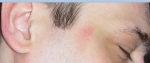 Красные болячки на лице с шелушением фото 1