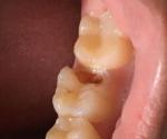 Болит зуб при надавливании фото 1