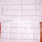 Лечение мерцательной аритмии, расшифровка ЭКГ и УЗИ сердца фото 1