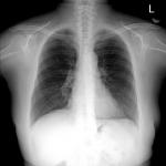 Ковид рентгенограмма легких в прямой и боковой проекциях фото 2