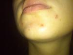Воспаления на лице с зудом и на теле фото 3