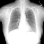 Ковид рентгенограмма легких в прямой и боковой проекциях фото 1