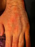 Раздражение кожи кистей рук фото 5