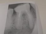 Воспаление корня 46 зуба+перфорация канала фото 2