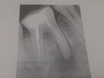 Воспаление корня 46 зуба+перфорация канала фото 3