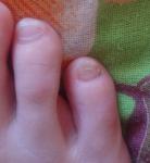 Полоски-трещины на ногте фото 1