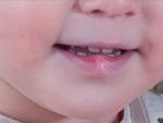 Рубец на губе у ребёнка фото 1